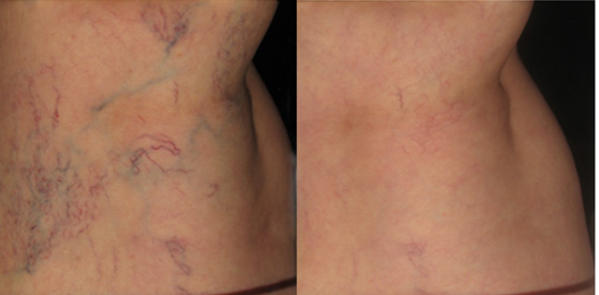 spider veins and varicose veins – what are they? why do we get them? can you treat them?