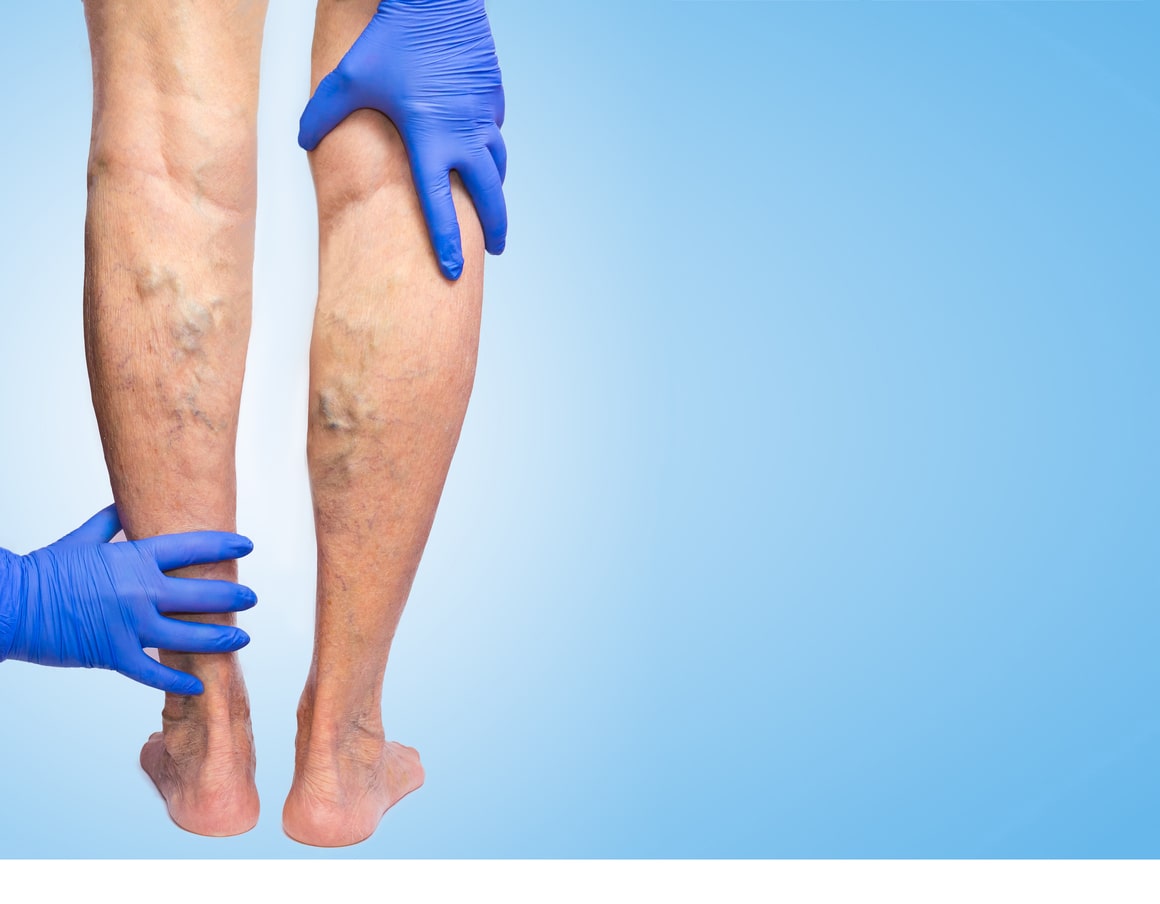 the perfect solution to get rid of unsightly spider veins