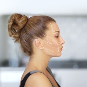 Woman with arrows on the side of her face demonstrating thread lifting. 