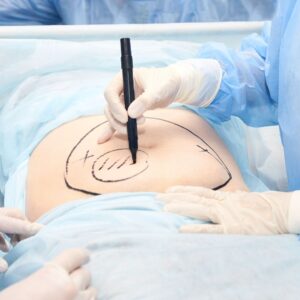 person getting liposuction