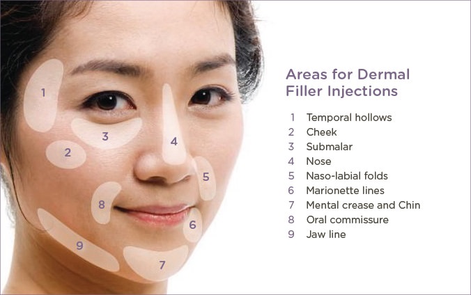 Areas of dermal fillers injections