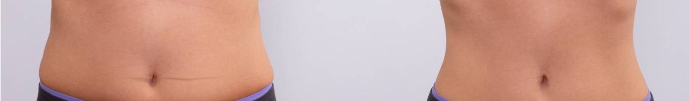 VASER LIPOSUCTION IN LOS ANGELES