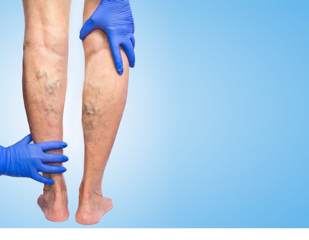 the perfect solution to get rid of unsightly spider veins