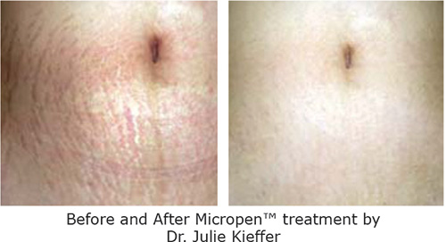 prp/micropen treatment