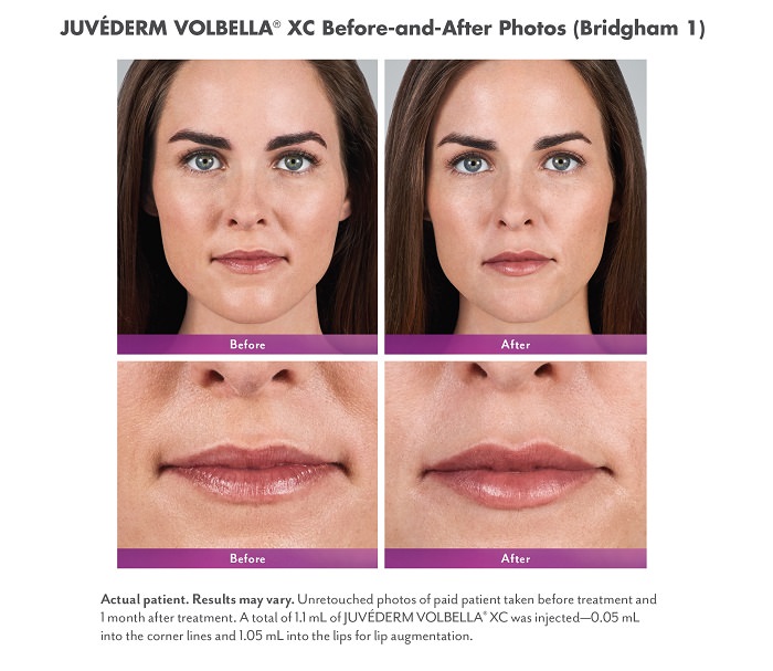 The Single Strategy To Use For Juvéderm™ Fillers - Franklin Dermatology Group & The ... thumbnail