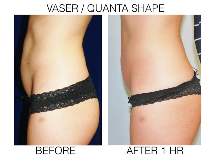 PDF] Use of VaserTM plus liposuction in body contouring surgery