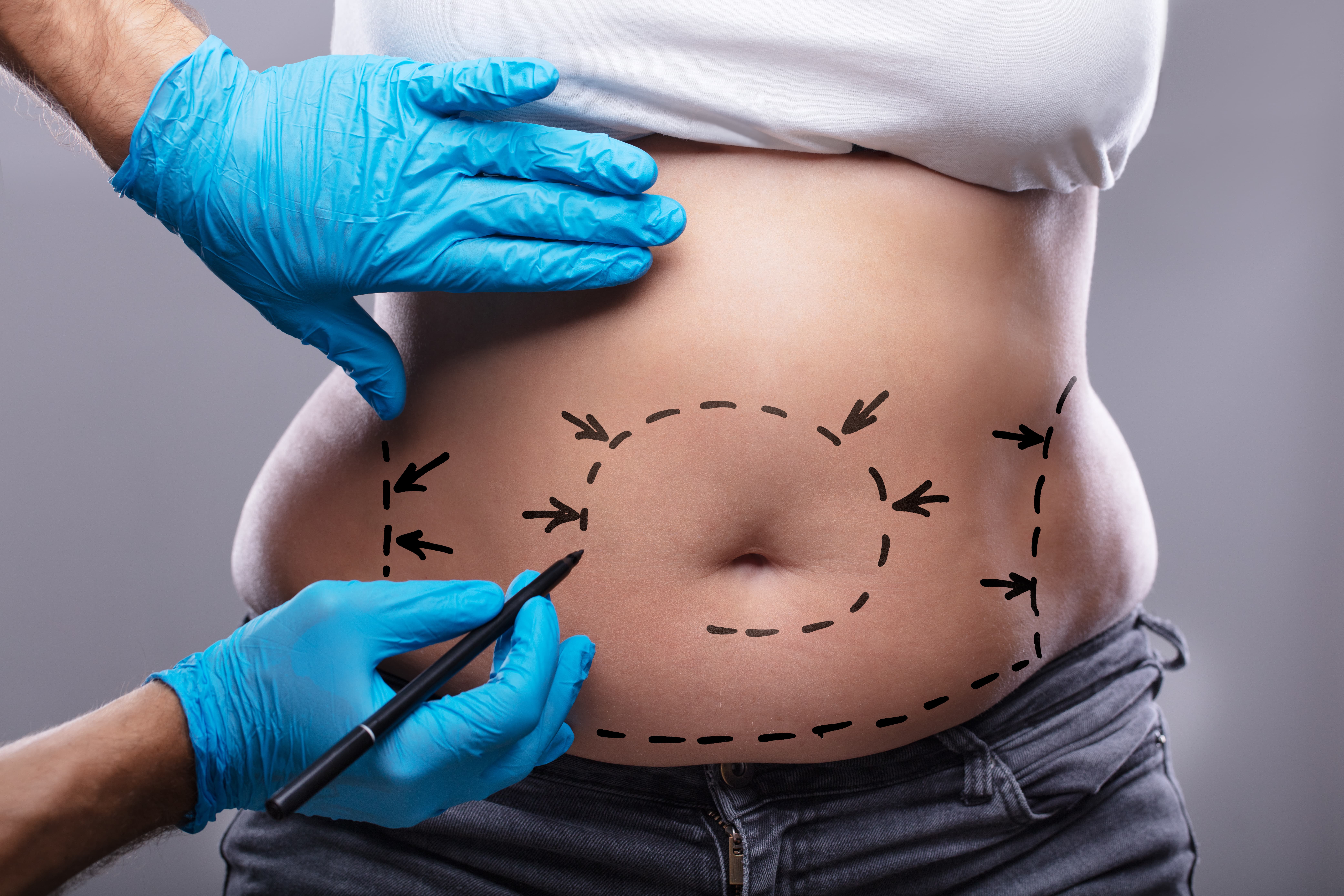 liposuction for fat reduction
