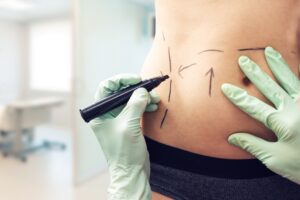 vaser liposuction to lose fat for the new year