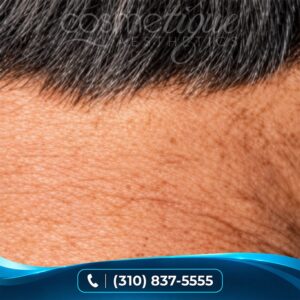 Laser Hair Removal (Starting at $60)
